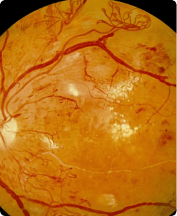 Donate for Retinopathy Treatment Donate for Retinopathy Treatment